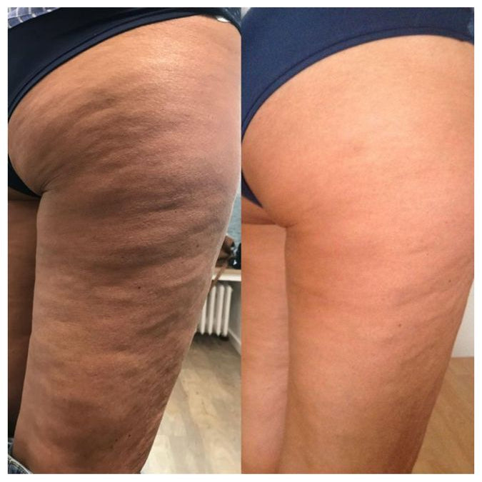 Crema Reafirmante Anticelulítica Termoactiva