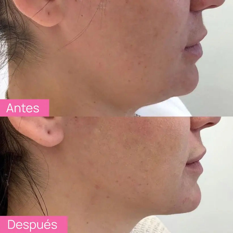 SKINDION | MASAJEADOR FACIAL DE MICROCORRIENTE + GEL CONDUCTOR DE REGALO