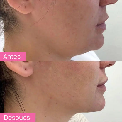 SKINDION | MASAJEADOR FACIAL DE MICROCORRIENTE + GEL CONDUCTOR DE REGALO